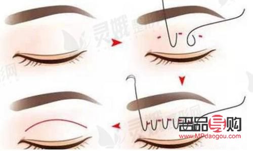 <h3>雙眼皮太寬如何巧妙變窄？專業技巧大揭秘</h3>