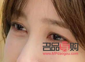 40歲眼皮松弛下垂：探尋最佳解決方案