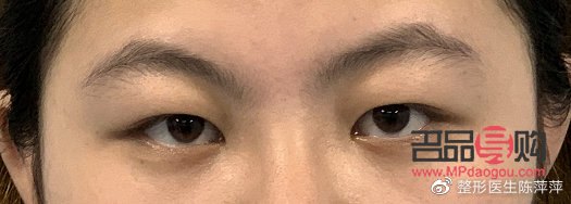腫眼泡是怎么回事？