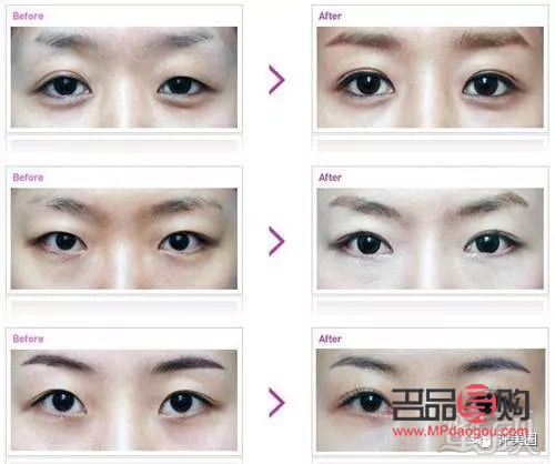 <h3>5G桃花眼雙眼皮手術風險解析</h3>