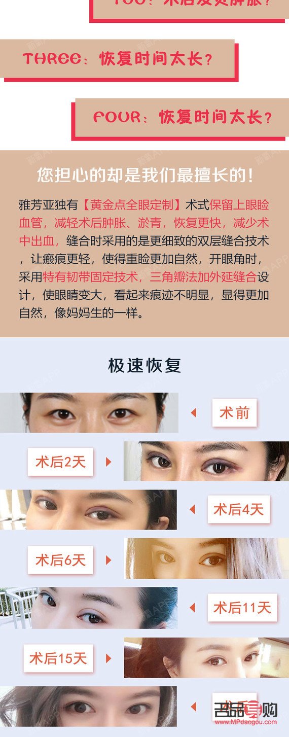 <h3>5G桃花眼雙眼皮手術風險解析</h3>