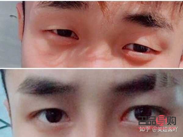 男生眼睛小怎么變大(男生眼睛小怎么變大不手術)
