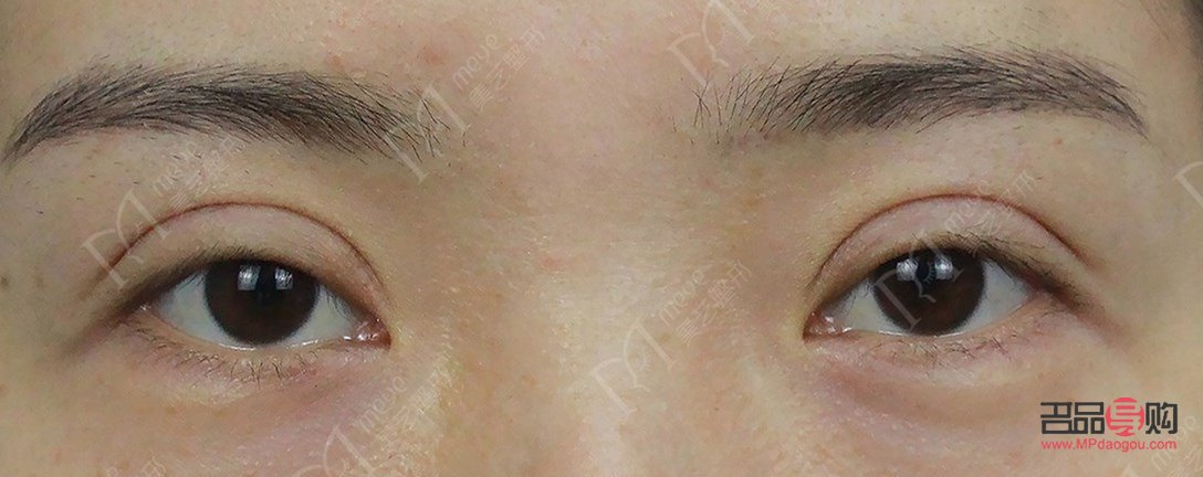 扇形雙眼皮給人的感覺(扇形雙眼皮給人的感覺怎么樣)