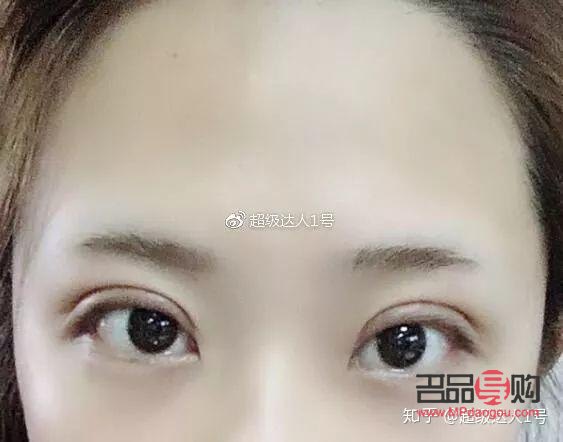 開(kāi)扇雙眼皮手術(shù)全解析