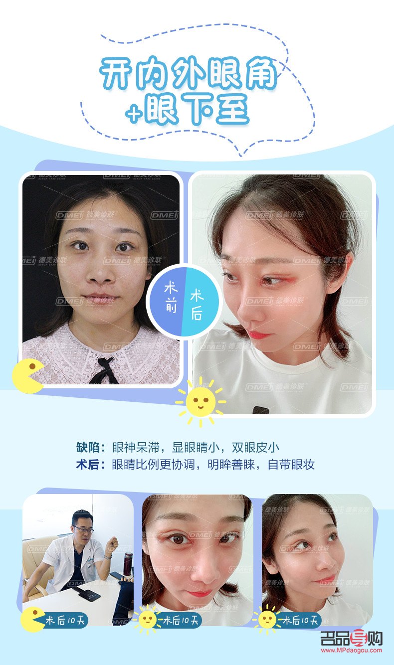 小眼睛開眼角雙眼皮效果(小眼睛開眼角雙眼皮效果好嗎)