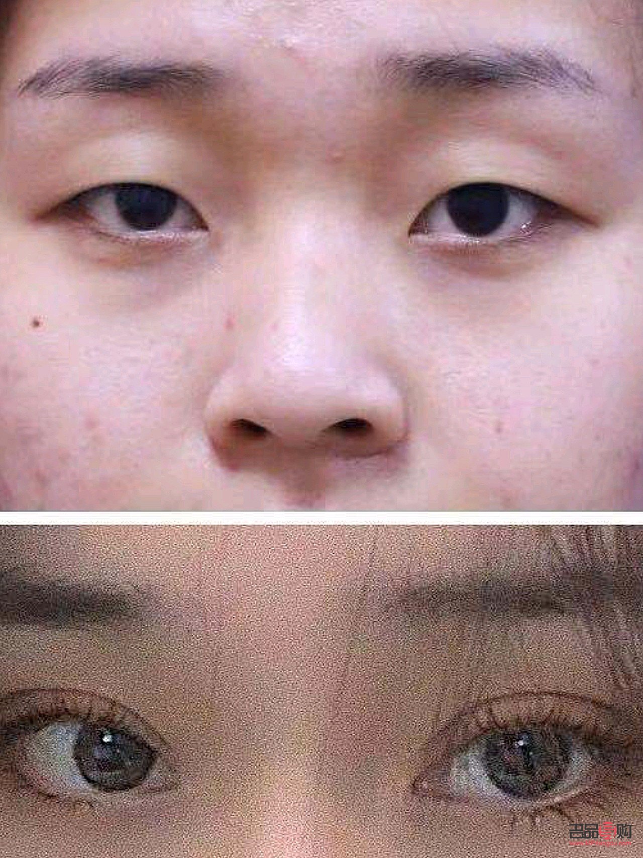 小眼睛開眼角雙眼皮效果(小眼睛開眼角雙眼皮效果好嗎)
