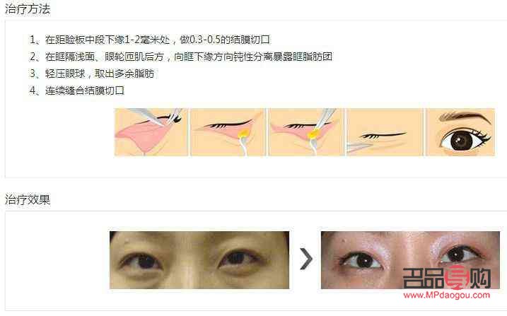 去眼袋多少錢標準收費(提眉術價格一般是多少)