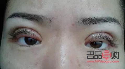 應(yīng)對過敏引發(fā)的上眼皮紅腫問題
