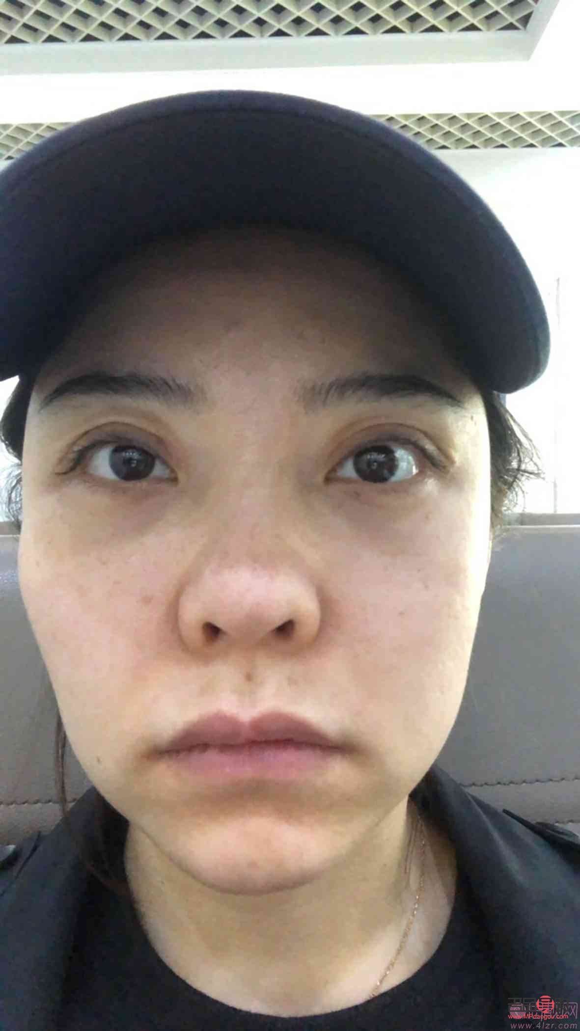 <h3>眼睛大小不一，手術可否解決？</h3>