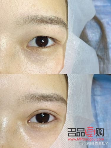 眼部抽脂有什么風險和后遺癥(腫眼泡去脂肪手術(shù)多少錢)
