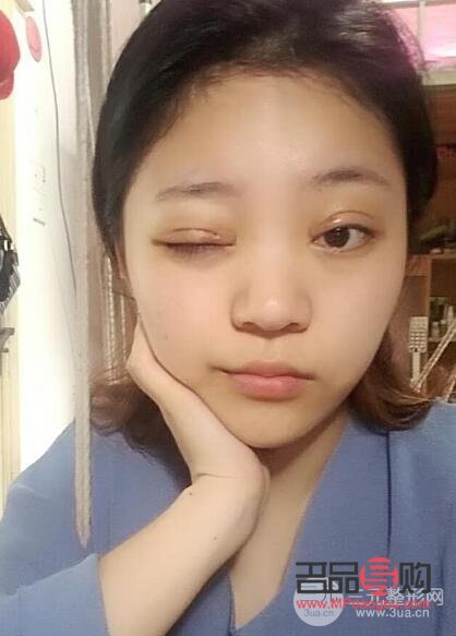 <h3>雙眼皮手術20天恢復圖詳解</h3>