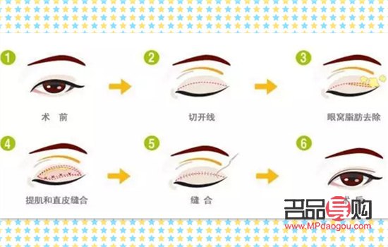 <h3>提眉與埋線雙眼皮：可否一并施行？</h3>
