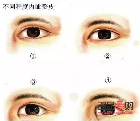 眼皮松全切雙眼皮會不會塌(眼皮松全切雙眼皮會不會塌下去)