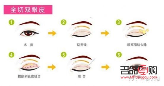 眼皮松全切雙眼皮會不會塌(眼皮松全切雙眼皮會不會塌下去)