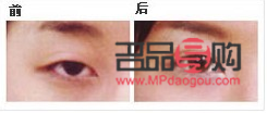 現在做雙眼皮的有哪種方式好(現在做雙眼皮的有哪種方式好呢)