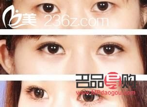 割雙眼皮對身體有什么影響(割雙眼皮對身體有什么影響嗎)