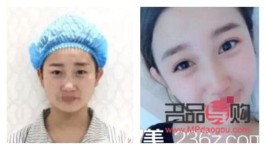 眼睛矯正手術大概多少錢住幾天住(眼睛矯正手術價格表)