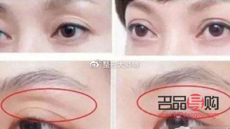 眼窩凹陷可以填充嗎？解析眼部填充手術