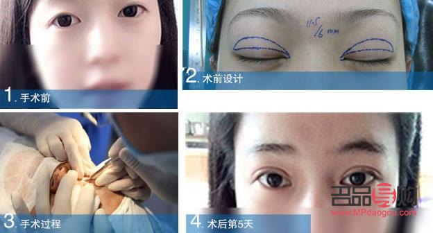 全切雙眼皮恢復(fù)過程全解析