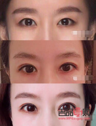 全切雙眼皮恢復(fù)過程全解析