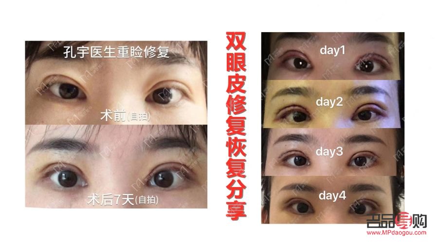全切雙眼皮恢復(fù)過程全解析