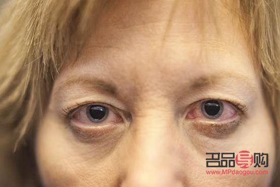 淚溝消除秘籍：告別疲憊，重拾青春明眸