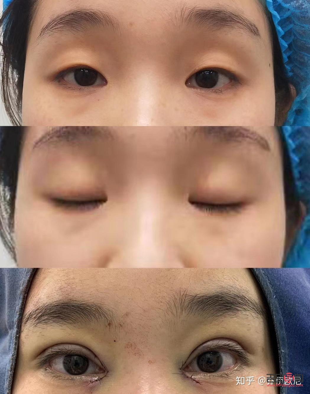 雙眼皮全切恢復期要多久才自然(雙眼皮全切恢復期要多久才自然好)
