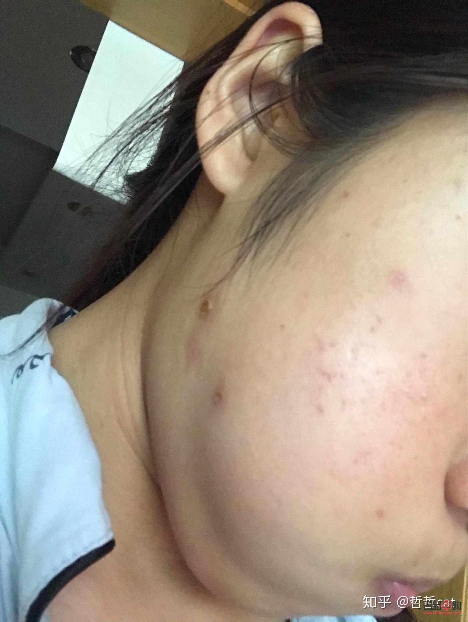 美容院點痣怎么點(美容院點痣怎么點的)
