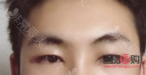 <h3>男人是否應該割雙眼皮？探討男性雙眼皮手術的利與弊</h3>
