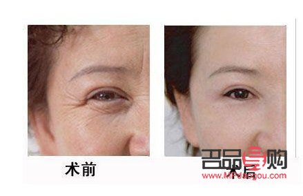眼部超聲刀怎么做(眼部超聲刀做完什么時(shí)候見效果)