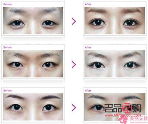 <h3>翹睫術(shù)雙眼皮效果能持續(xù)多久？</h3>