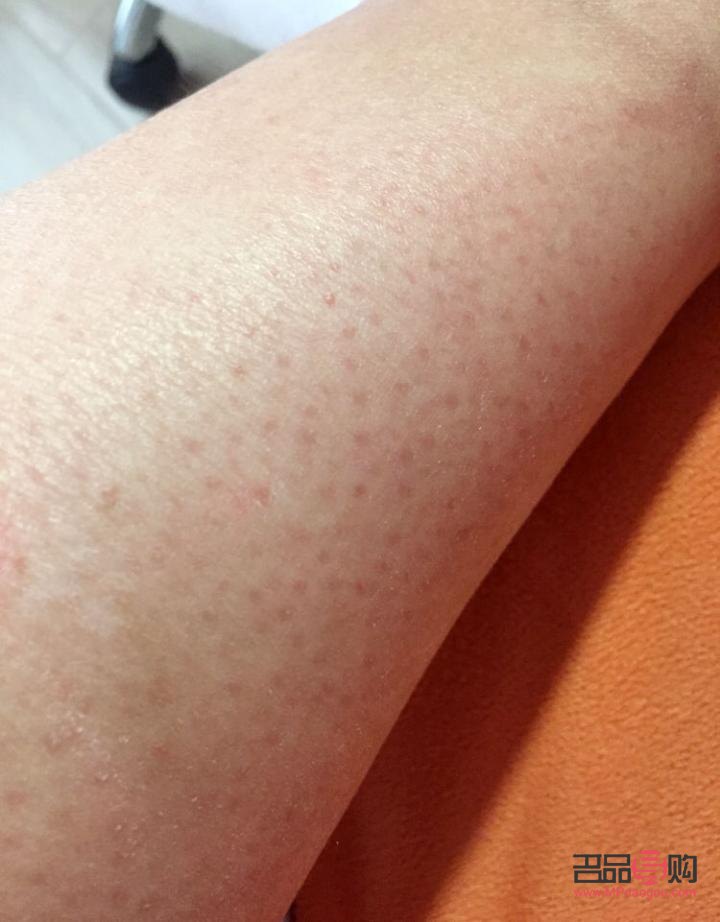 身體雞皮膚怎么護理(身上的雞皮膚怎么治)