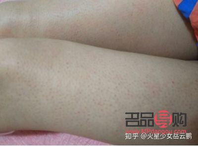 身體雞皮膚怎么護理(身上的雞皮膚怎么治)