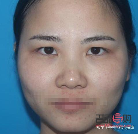 <h3>割雙眼皮大小眼：手術風險與美學考量</h3>