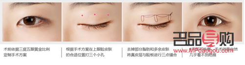 割雙眼皮大小眼：手術(shù)風(fēng)險(xiǎn)與美學(xué)考量