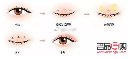 現在流行什么雙眼皮技術(現在流行什么雙眼皮技術呢)