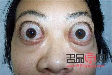 甲亢眼睛突出做手術要多少費用(甲亢眼睛突出做手術要多少費用呢)