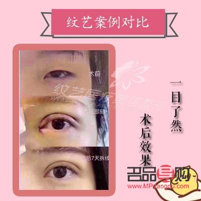 全切雙眼皮幾天恢復(fù)(全切雙眼皮幾天恢復(fù)正常)