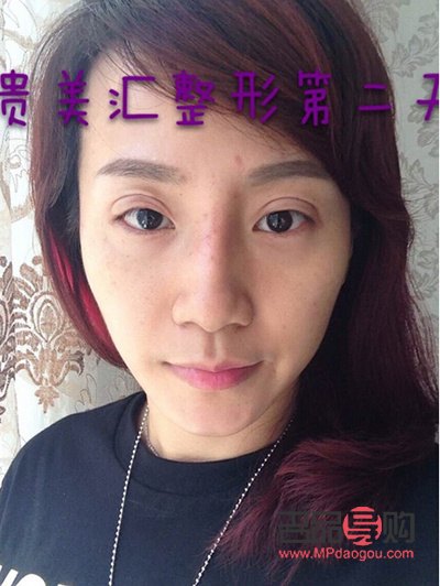 雙眼皮定位解析：了解雙眼皮美容手術(shù)的關(guān)鍵一步