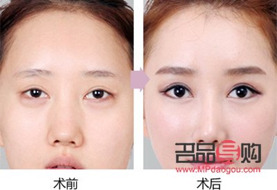 中國雙眼皮修復人：塑造美麗新傳奇