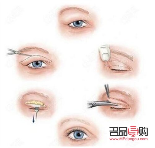 <h3>雙眼皮手術：現代流行的眼部美容新選擇</h3>