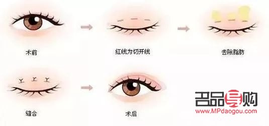 <h3>雙眼皮手術：現代流行的眼部美容新選擇</h3>