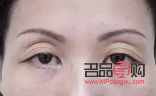 眼睛周圍凹陷怎么恢復飽滿圖片(眼睛周圍凹陷怎么恢復飽滿圖片女)