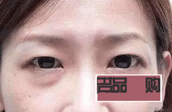 眼睛周圍凹陷怎么恢復飽滿圖片(眼睛周圍凹陷怎么恢復飽滿圖片女)