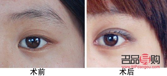 開眼角手術費多少(開眼角手術費多少錢一次)