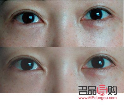 <h3>眼睛手術恢復正常的時長探究</h3>