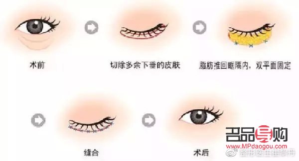 <h3>眼睛手術恢復正常的時長探究</h3>
