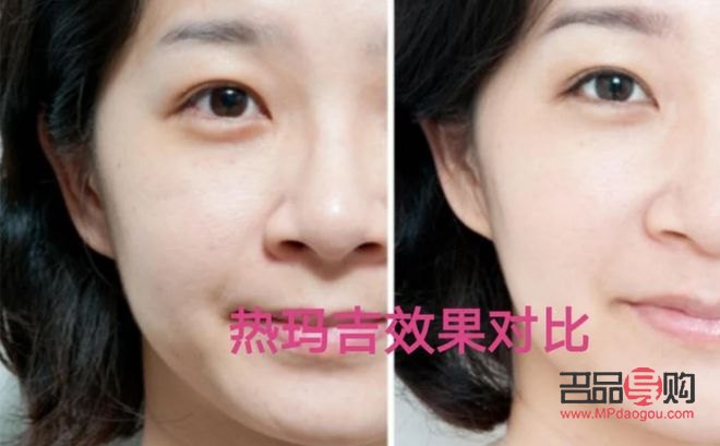 美容縫線多少錢(美容縫線多少錢一針)