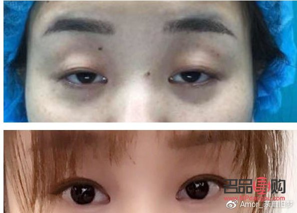 割雙眼皮提肌與不提肌的區別(眼睛提肌有必要做嗎)