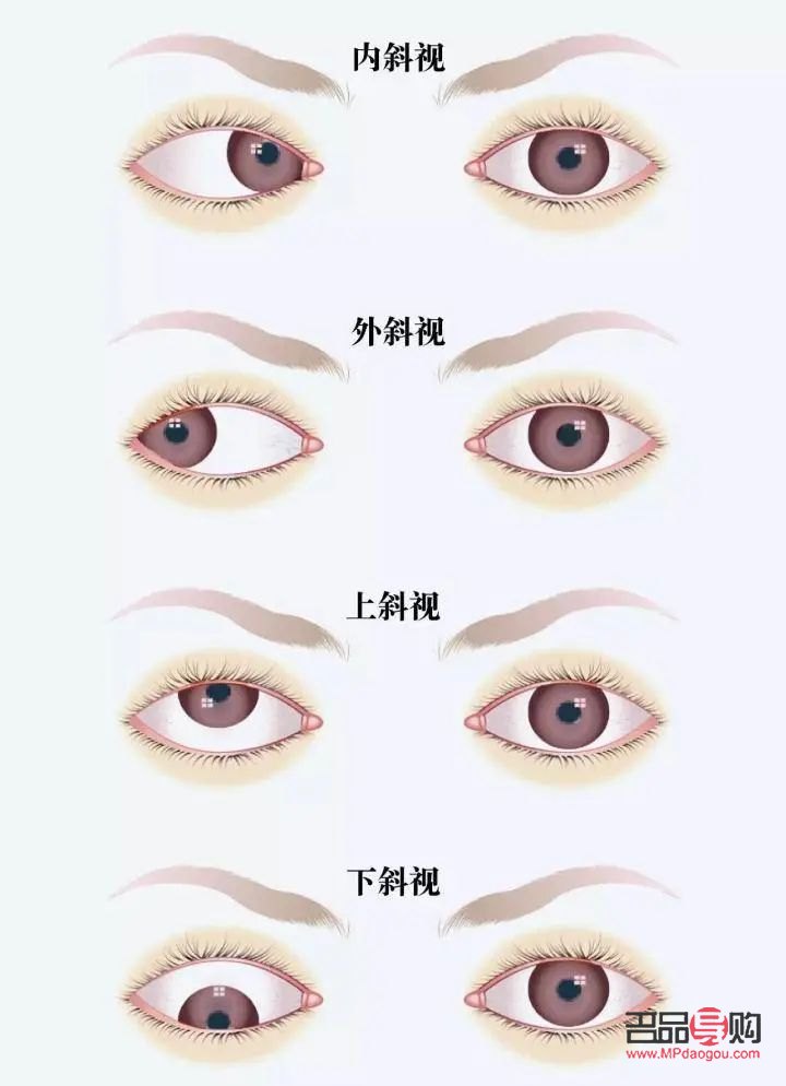 <h3>天生大小眼問題解析：女生是否能進行矯正？</h3>